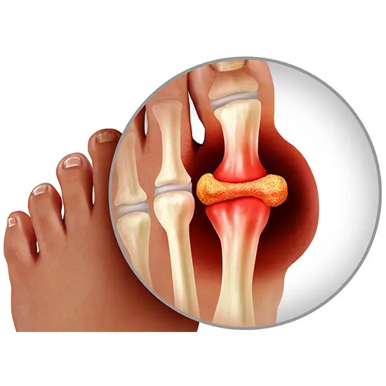 Bone And Joint Disease Panel, Serum